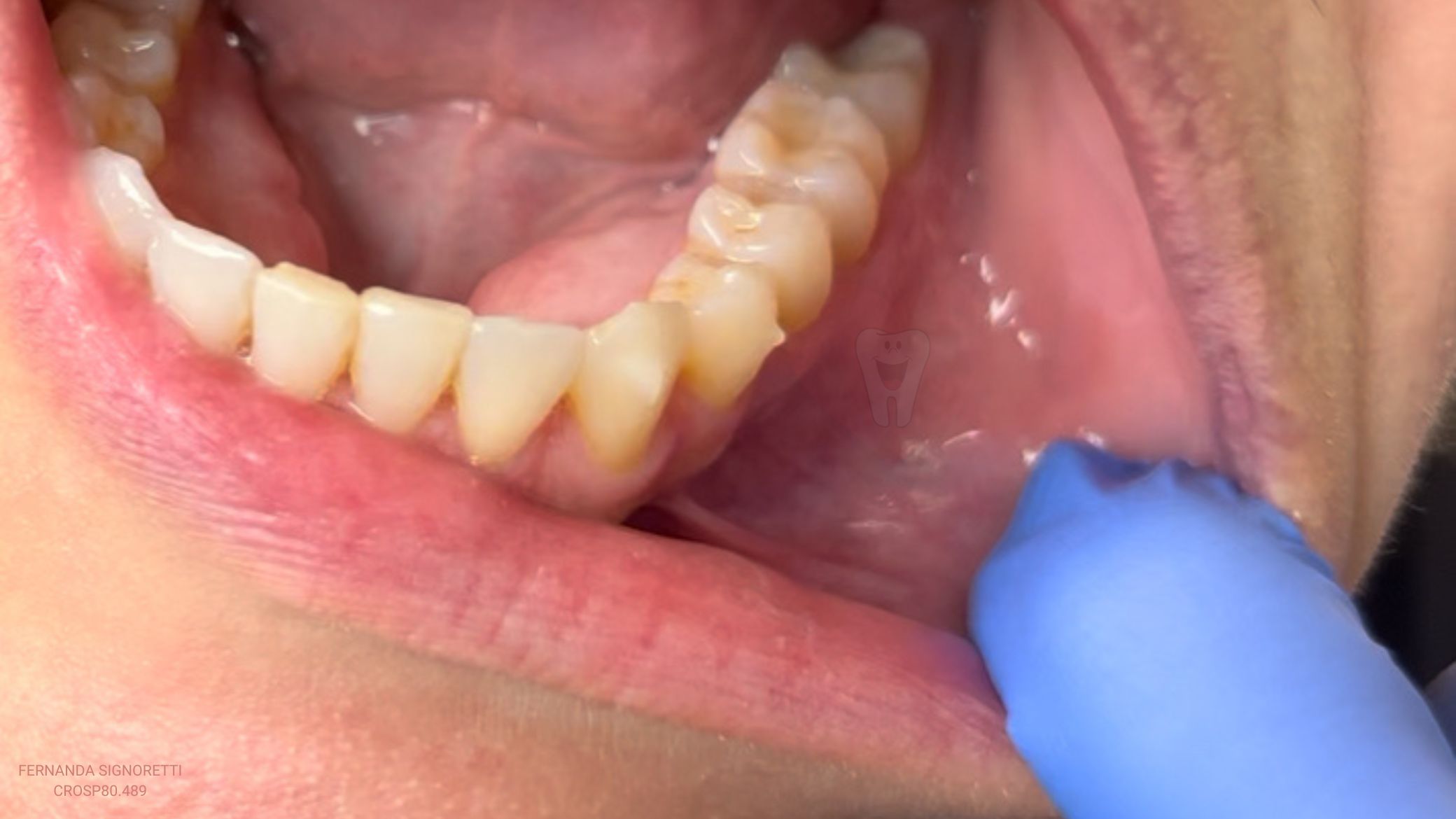 Anestesia Que ‘Não Pega’ na Hora do Canal?